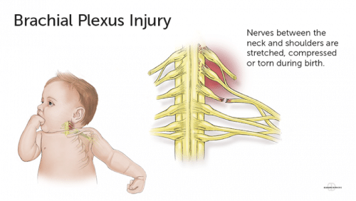 Diagram of baby and Brachial Plexus injury